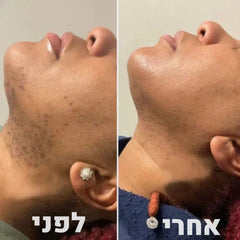 ערכת הסרת שיער מלאה koncherto