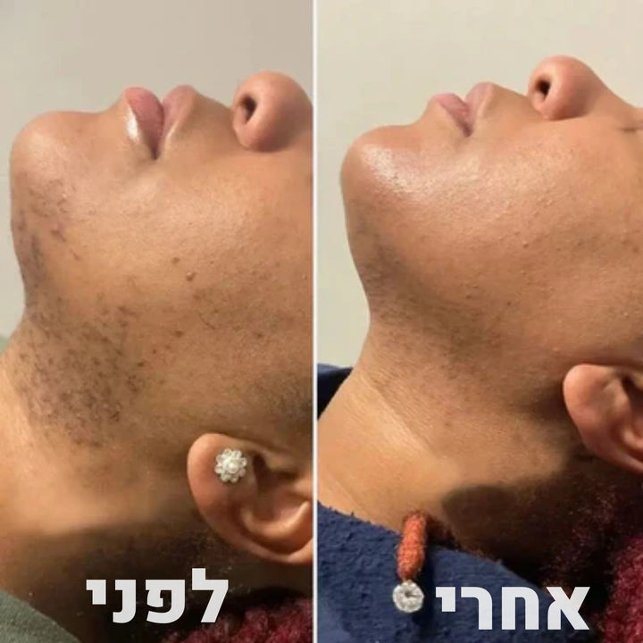 ערכת הסרת שיער מלאה koncherto