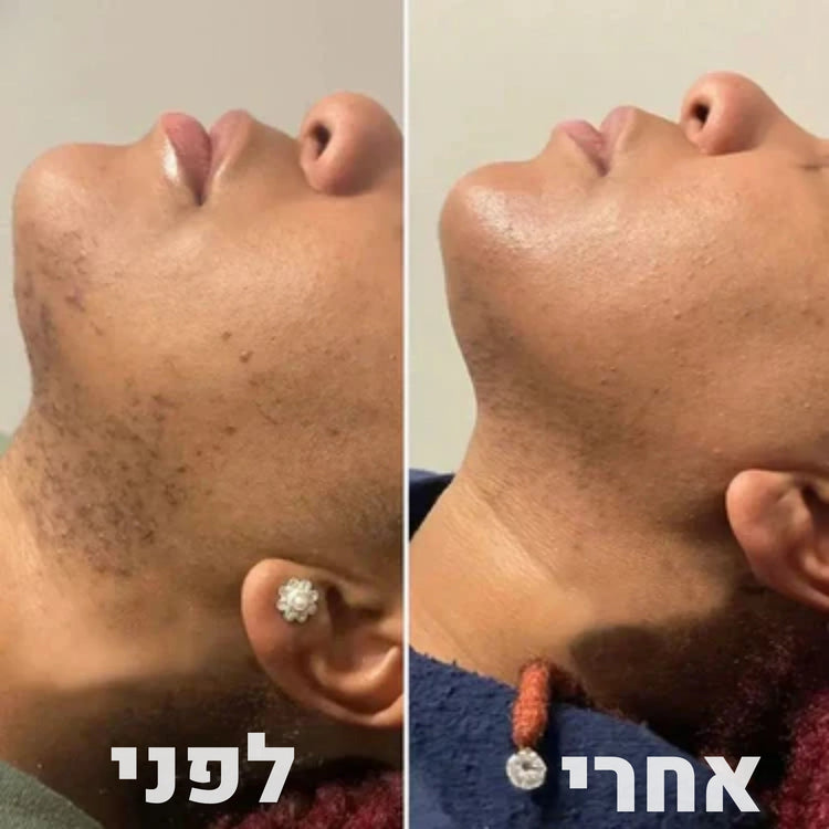 ערכת הסרת שיער מלאה koncherto